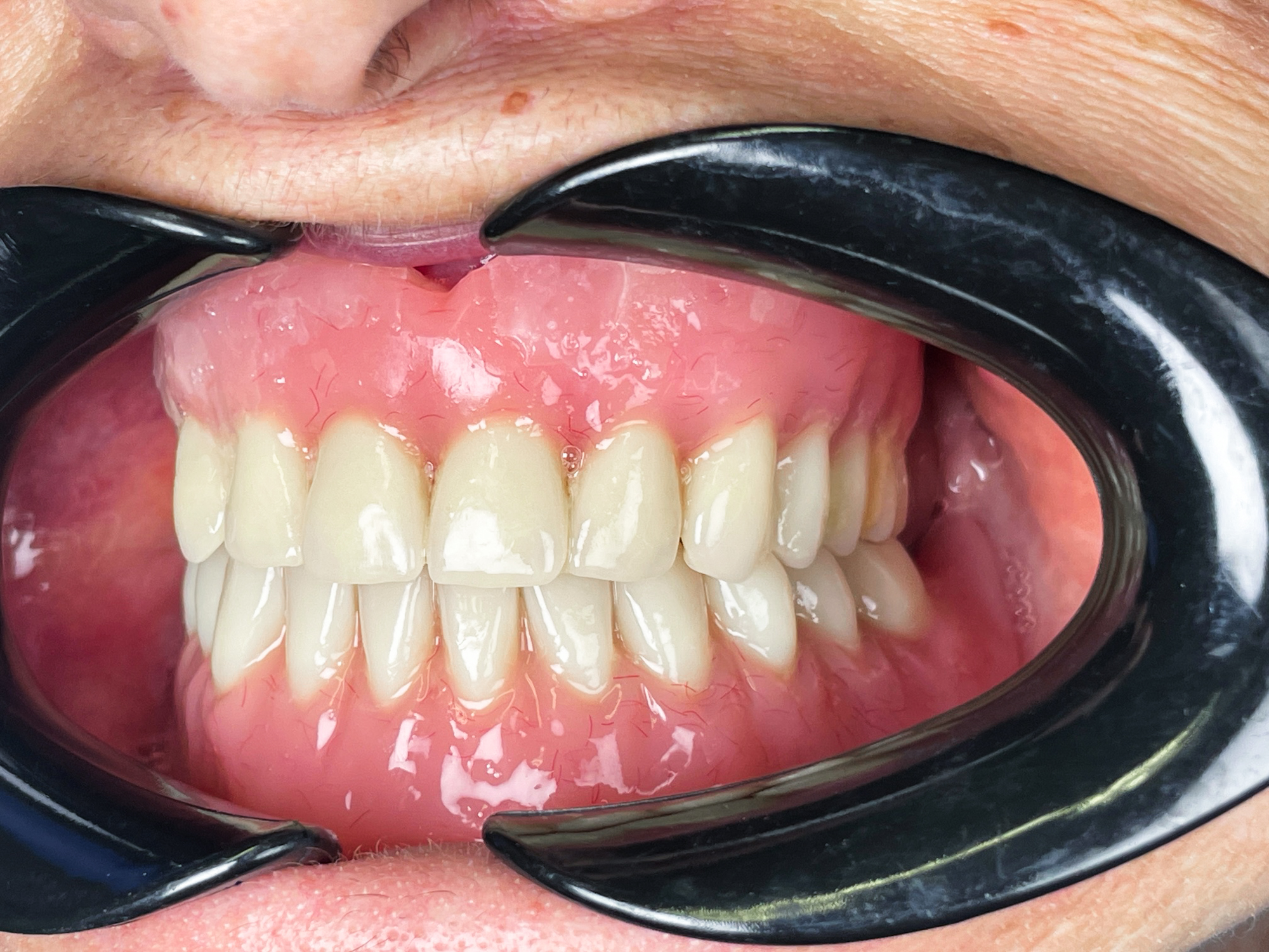 Overdenture su barra - Odontotecnica Castellana