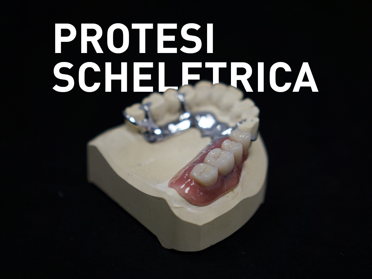Protesi scheletrica - Odontotecnica Castellana