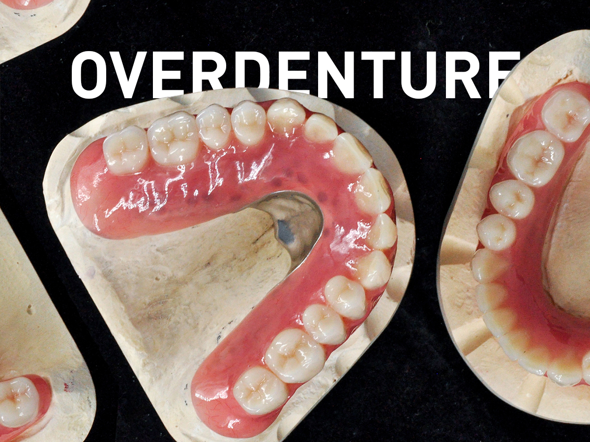 Overdenture - Odontotecnica Castellana
